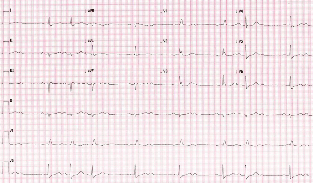 EKG spori ritam srca