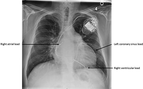 Pejsmejker za korekciju srčane slabosti